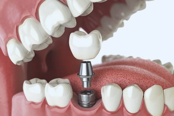 Dental Implants at Just Dent