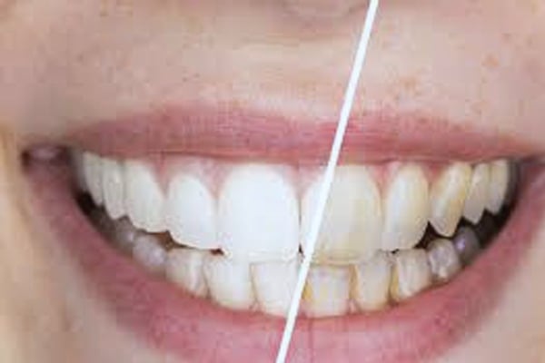 Routine Teeth Cleaning or Scaling at Just Dent