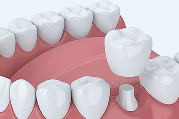 CAD/CAM Restorations